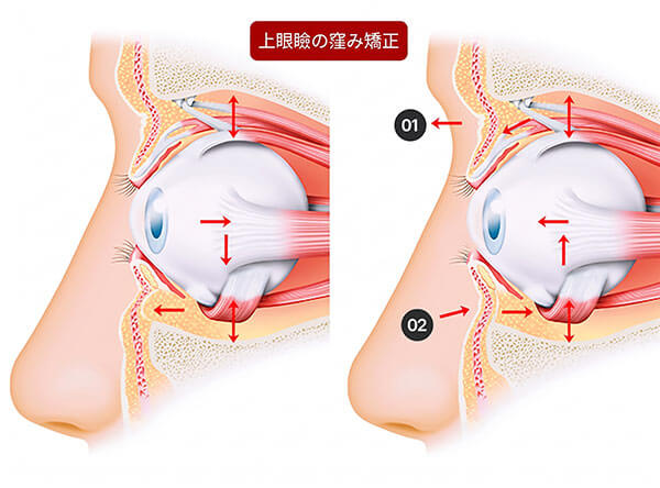 くぼみ目矯正後の脂肪移動メカニズム