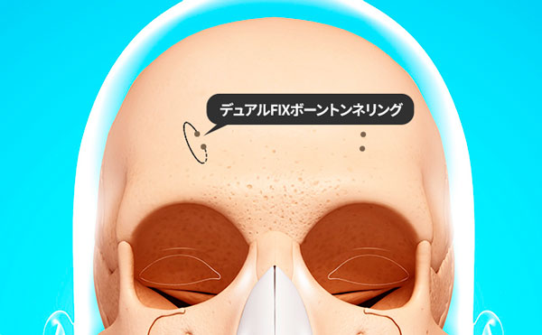 ボーントンネリング方式による額縮小術の固定方法