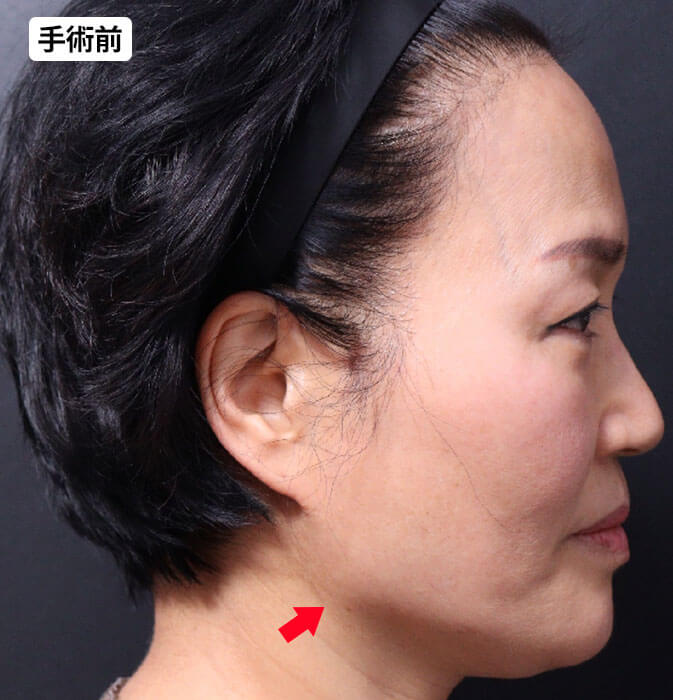 フェイスライン脂肪吸引