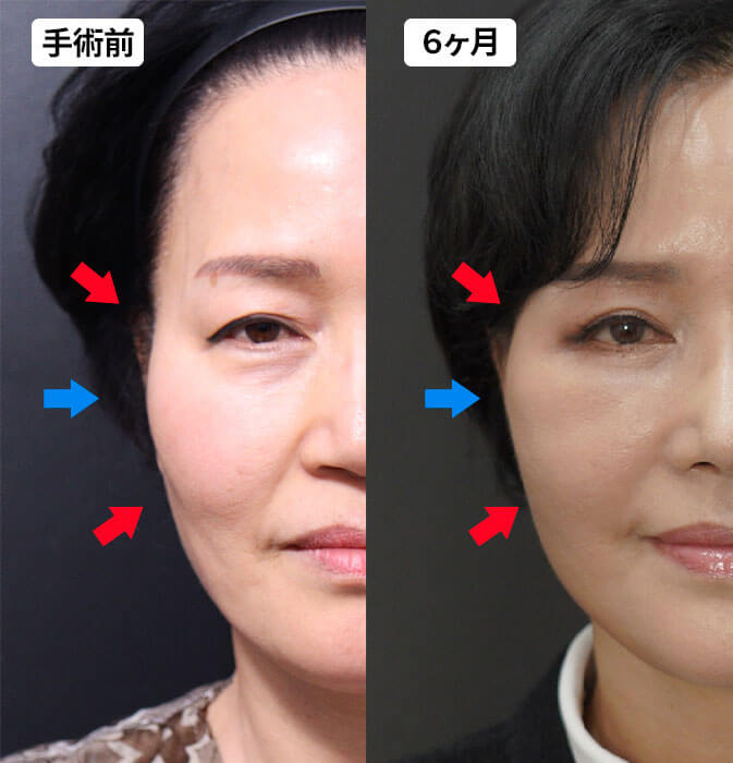 フェイスリフト頬のこけ