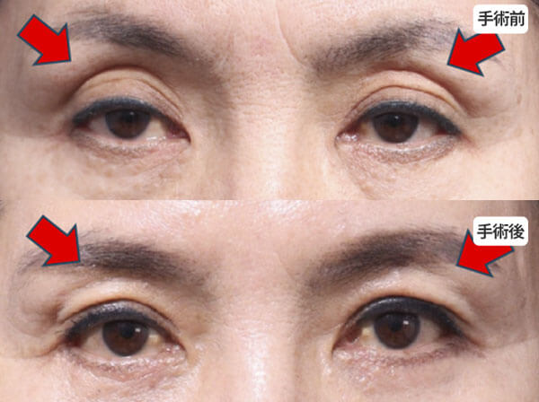 下眼瞼隔膜強化手術後の症例