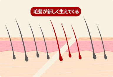 切開部位の毛根を温存