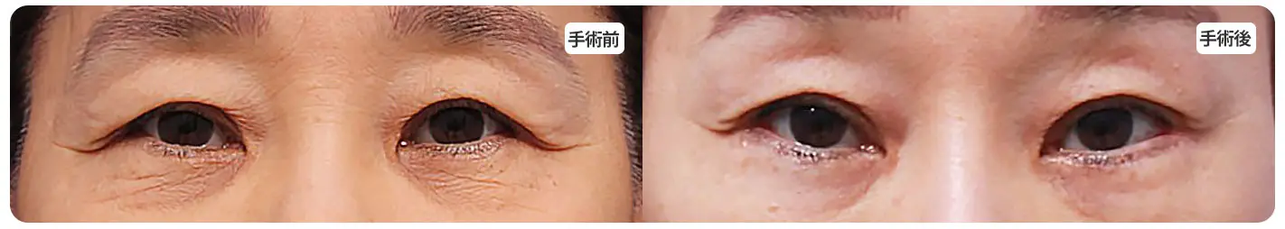 目尻リフト１