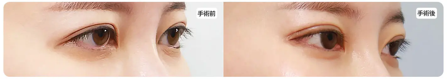 ネコ目整形