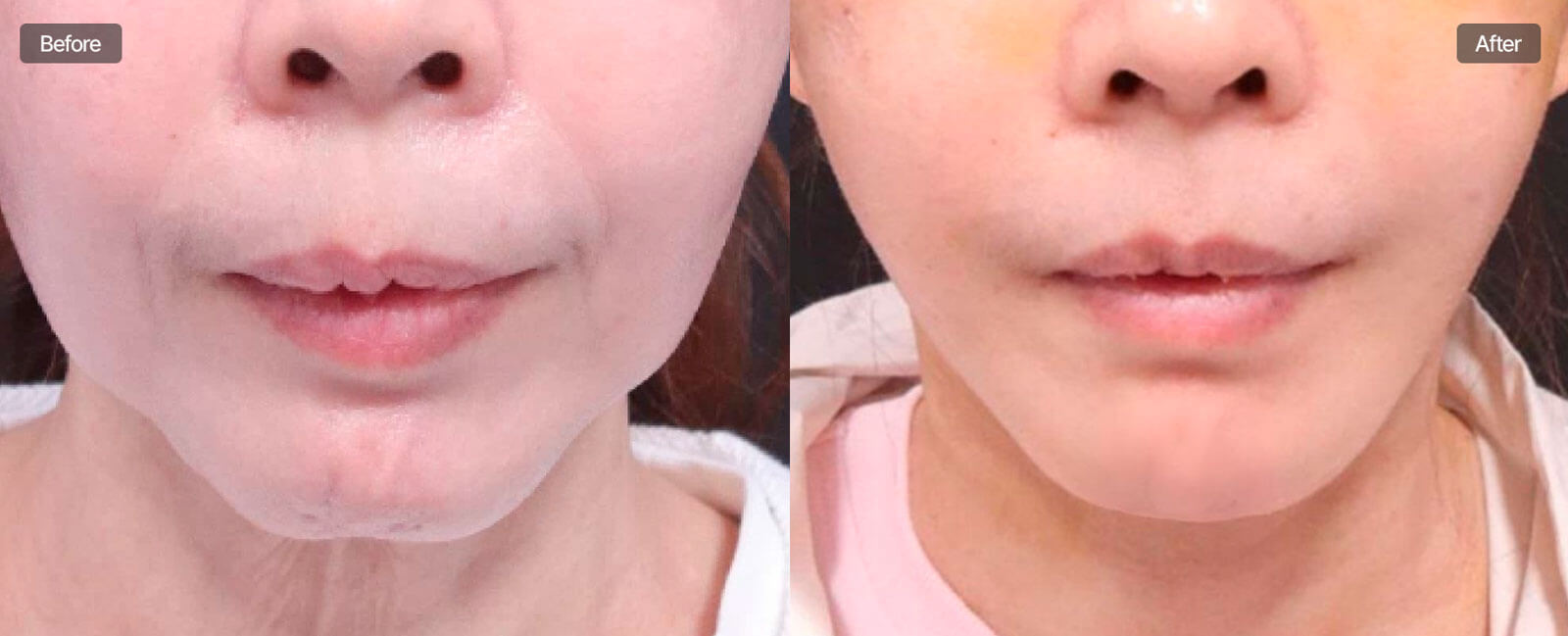魔女顎手術症例写真 Before After 口唇閉鎖不全
