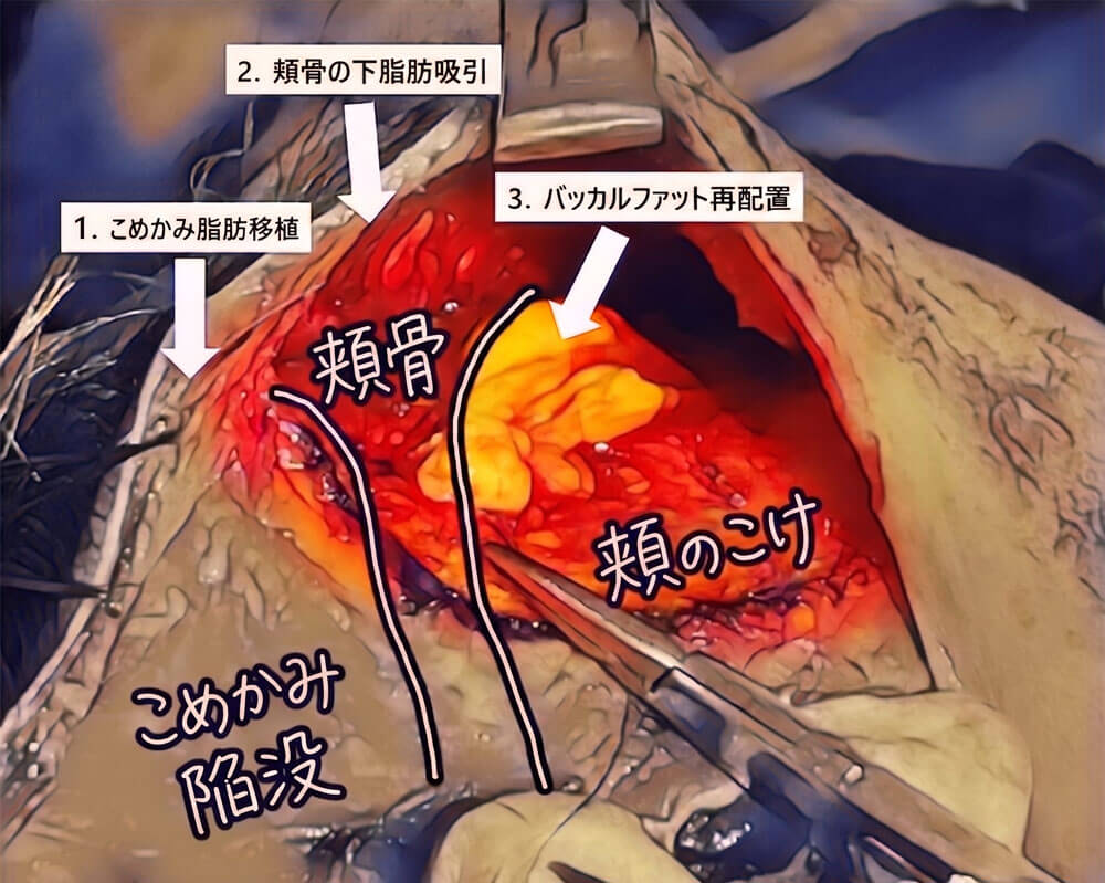 頬骨下脂肪吸引2