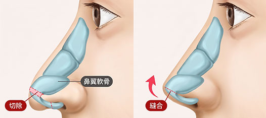 長い鼻矯正 翼軟骨が処진した症例