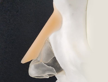 ３Dプロテーゼ