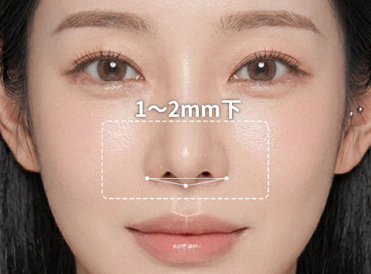 手術後:鼻翼から鼻柱までバランスの取れた三角点を成す状態