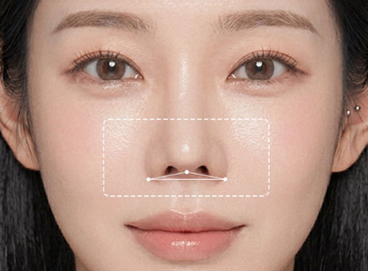 手術前:鼻柱より鼻翼が下がった三角点で矯正が必要な状態
