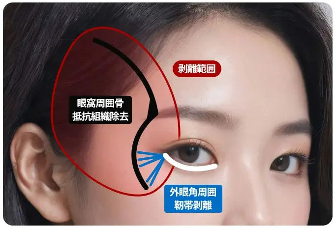 about fox eye lift