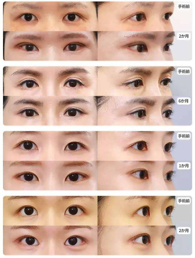 fox-eye-case2