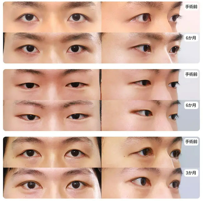 fox-eye-case3