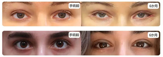 fox-eye-case5