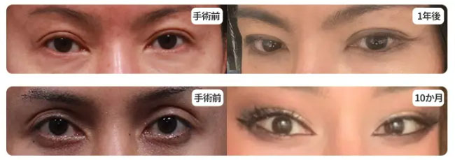 fox-eye-case6