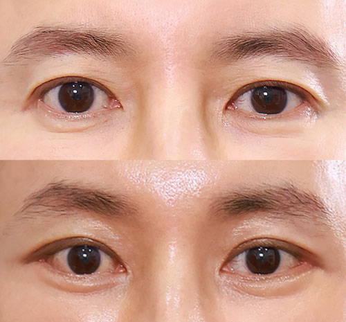 fox eye lift