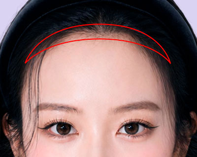 ヘアライン切開:ヘアラインとおでこ部位を切開