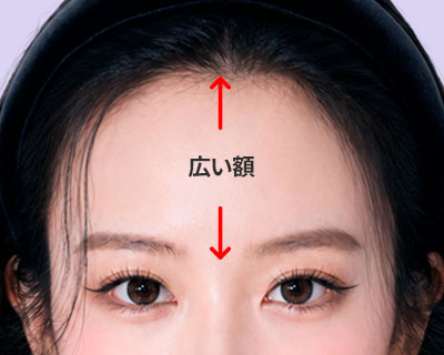 手術前:顔の比率に合わずおでこが広い状態
