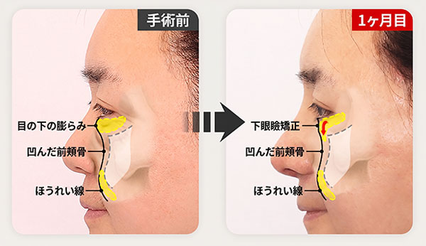 単純下眼瞼形成 施術前後比較