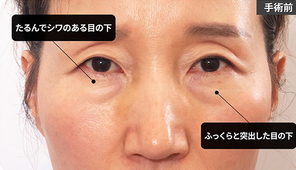 たるんで突出した目の下 手術前