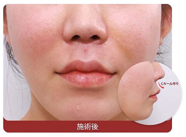 明確な人中溝と立体感が生まれた人中溝形成術の術後状態