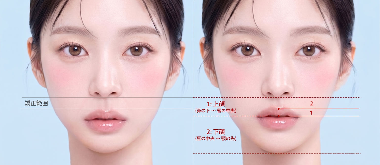 人中縮小術による老け顔比率と童顔比率の理想的な人中比率比較