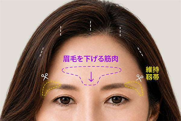 骨膜・筋膜の十分な剥離、維持靭帯のカットと眉を下げる筋肉の弱化