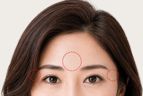 額挙上後、おでこ・眉間・目元のしわ、たるみの改善