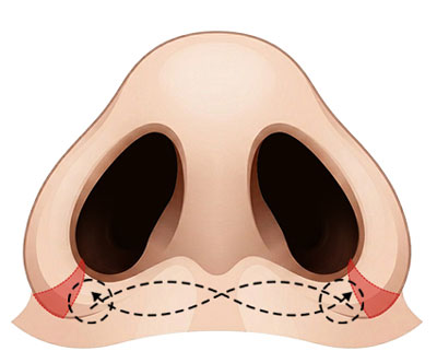 小鼻縮小手術 STEP2 縫合