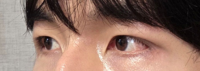 眉骨削り側面 アフター写真