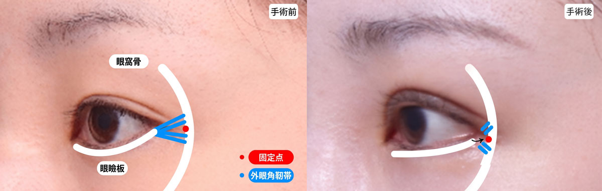 外眼角靭帯切離と瞼板固定による目尻たれ目手術前後比較