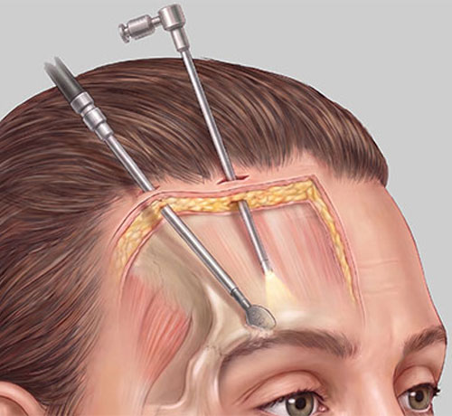 額切開による眉骨シェービング手術のアプローチ