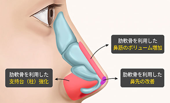 肋軟骨を用いた鼻柱支柱強化と鼻先形成