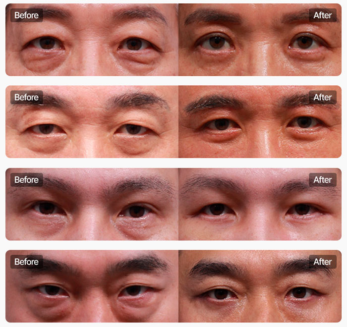 中年男性 バタフライハムラ手術結果