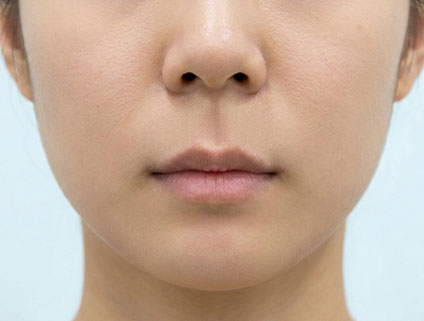 先天的に長い人中の正面写真