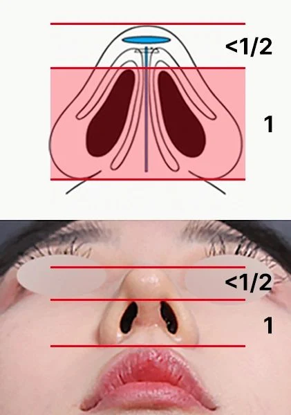 Case01 鼻孔が長い場合の比率図