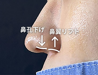 鼻翼挙上