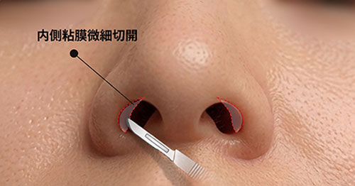 鼻翼内側の粘膜微細切開による鼻翼下垂改善手術