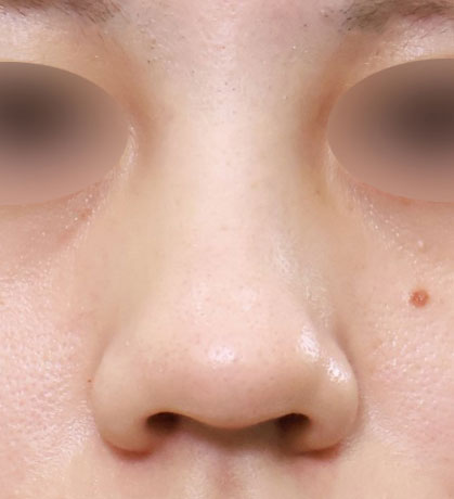 鼻柱より小鼻が下がった形状で矯正が必要な状態