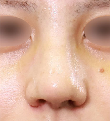 小鼻から鼻柱までバランスの取れた術後の状態