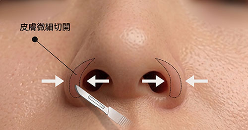 鼻翼ライン皮膚の微細切除による厚み改善手術