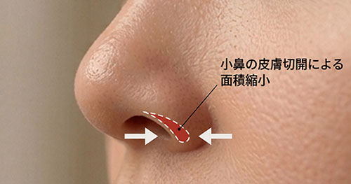 鼻翼皮膚切開による面積縮小後のスリムな鼻先