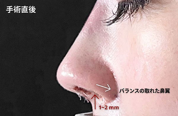 手術直後:理想的な角度で調和のとれた鼻翼